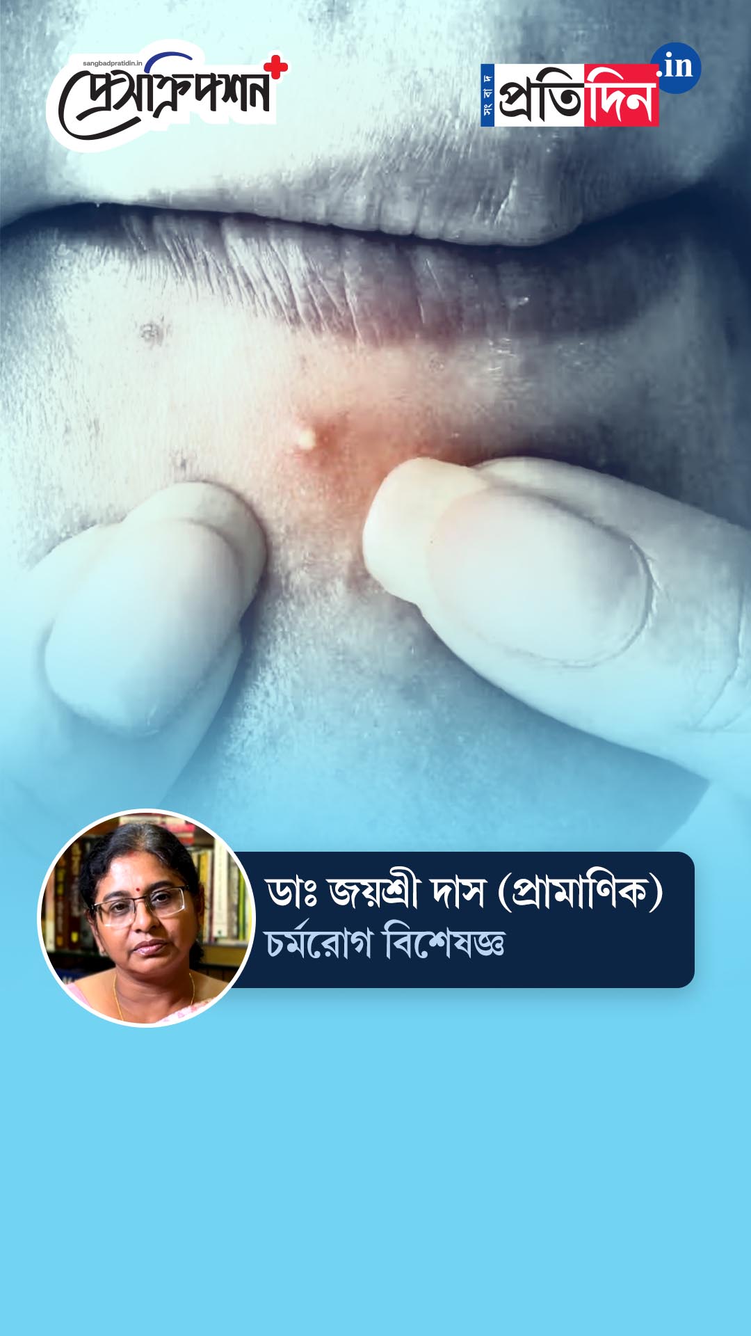 Skincare Tips: ব্রণ হলে কী কী করবেন না? জানাচ্ছেন ডাঃ জয়শ্রী প্রামাণিক দাস | Sangbad Pratidin